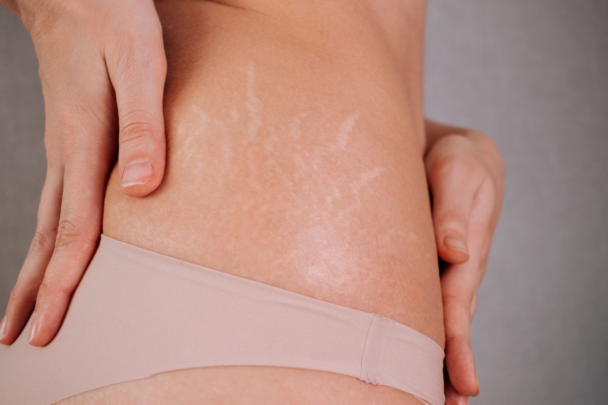 Hands framing the stretchmarks on the skin of a woman's hip.