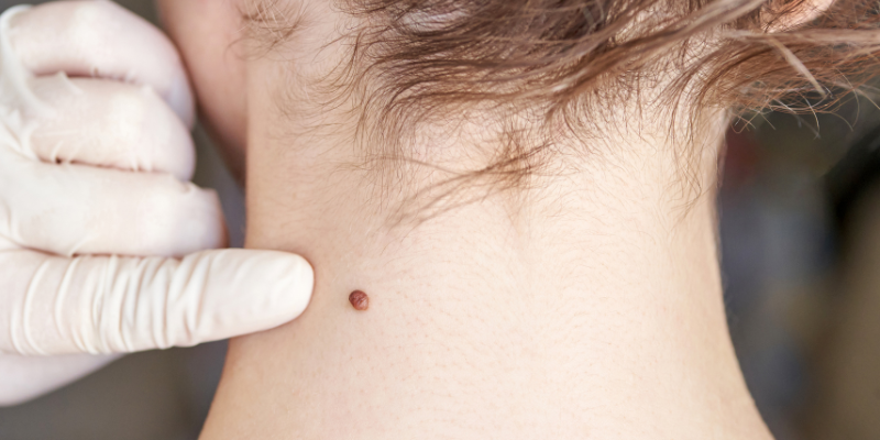 A white gloved dermatologist's hand inspects a small mole on the back of a person's neck.
